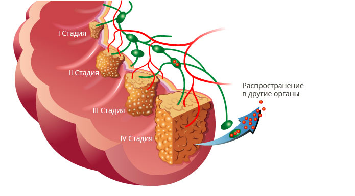 2 стадия рака кишечника