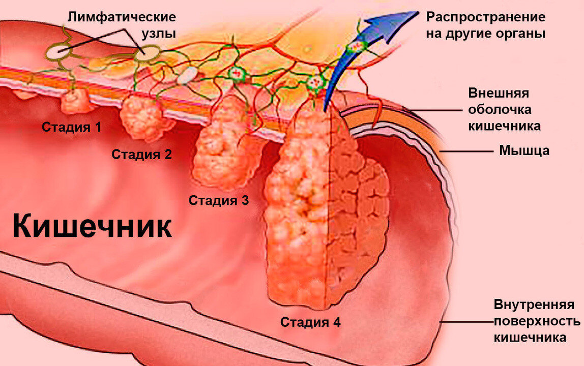 Стадии опухоли толстой кишки. Раковые новообразования прямой кишки. Опухоль ободочной кишки. Раковая опухоль толстой кишки.