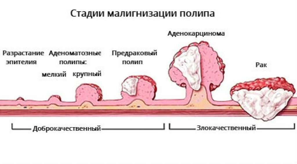 Рак толстой кишки боли