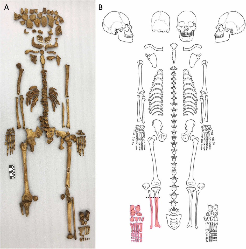   Nicole Hughes et al. / International Journal of Paleopathology, 2024