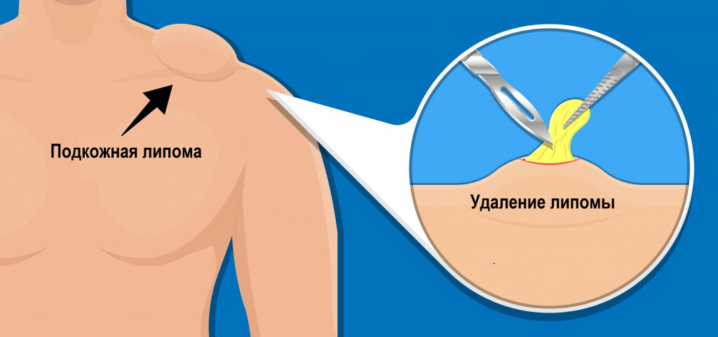 Как удалить жировик без хирургического вмешательства