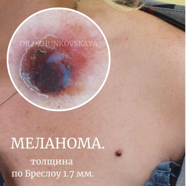 узловая меланома