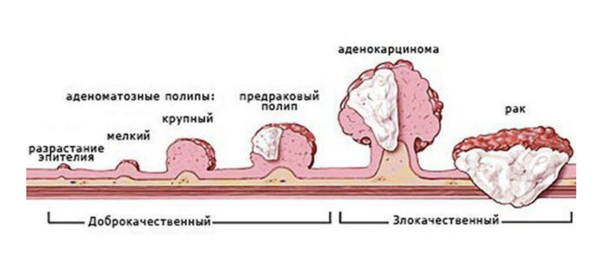 Эпителиальное образование желудка что это