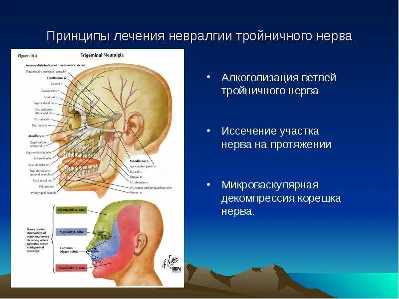 Neuralgia тройничный нерв. Невралгия 2 ветви тройничного нерва. Операция микроваскулярная декомпрессия тройничного нерва. Неврология тройничный нерв симптомы.