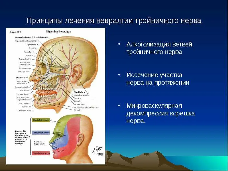 Болезнь тройничного нерва