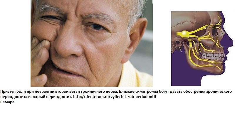 Неврология 3 ветви тройничного нерва. Триггерные зоны при невралгии тройничного нерва. Операция при невралгии тройничного нерва. Характерный признак невралгии тройничного нерва. Воспаление третичного нерва.