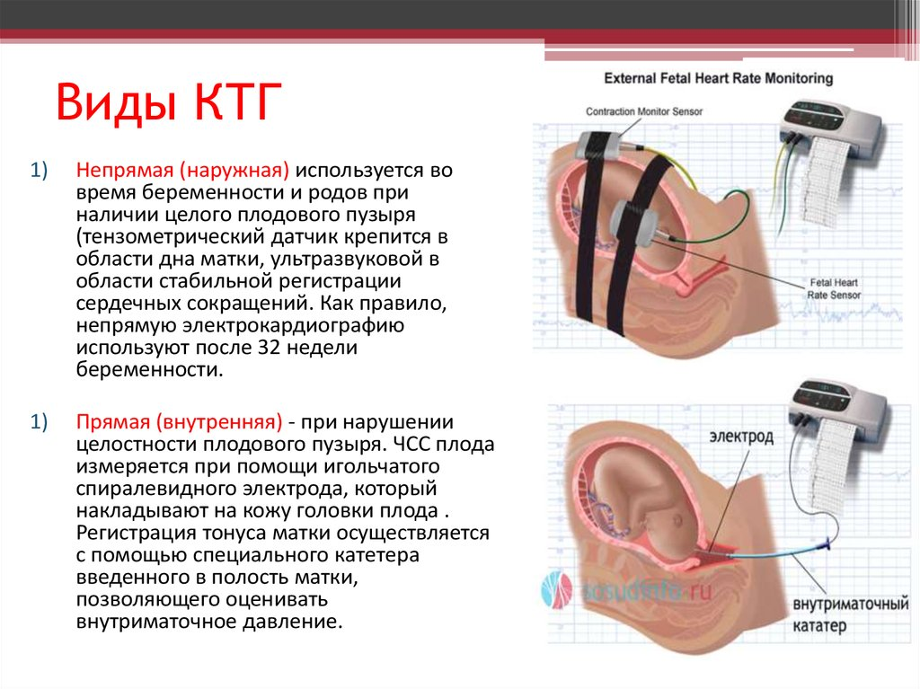 Как правильно снимать ктг