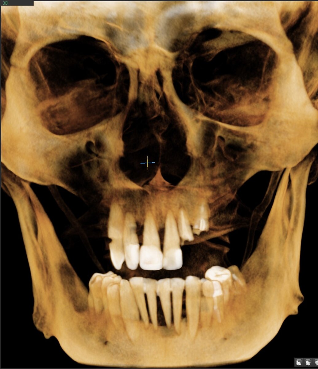 Хронический генерализованный пародонтит