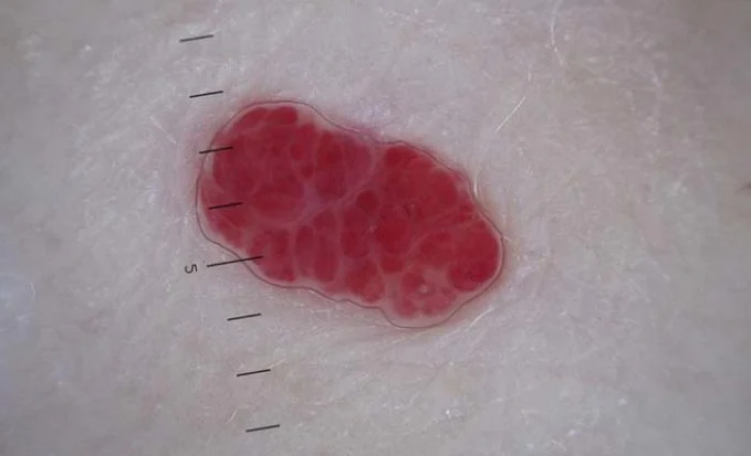 Что может означать появление красных точек на коже?