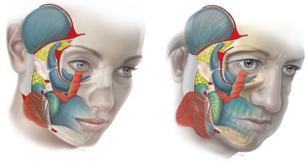 Иллюстрация на тему старения связочного аппарата лица