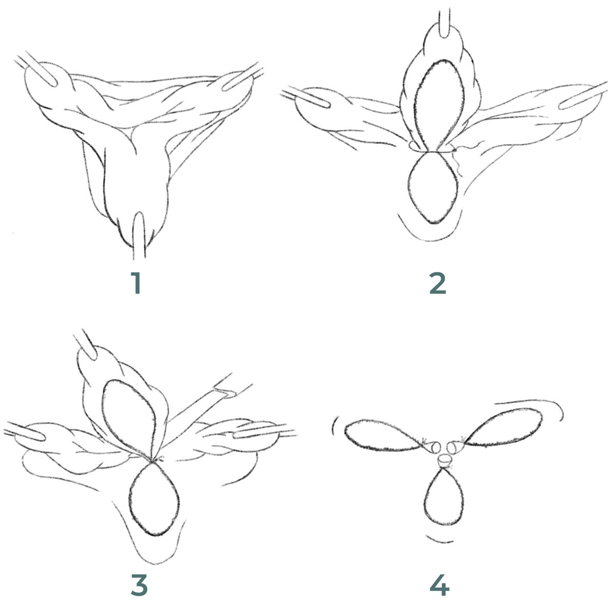 Этапы выполнения открытой геморроидэктомии.
1. Захват и растяжение трех основных геморроидальных узлов зажимами; 2. Препаровка геморроидальных узлов до ножки и её перевязка; 3. Отсечение геморроидального узла; 4. Гемостаз и окончание операции