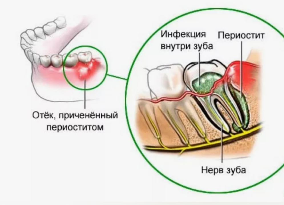 Почему немеют зубы. Периостит челюсти (флюс). Периостит челюсти схема. Периостит надкостницы зуба. Периостит надкостницы челюсти.