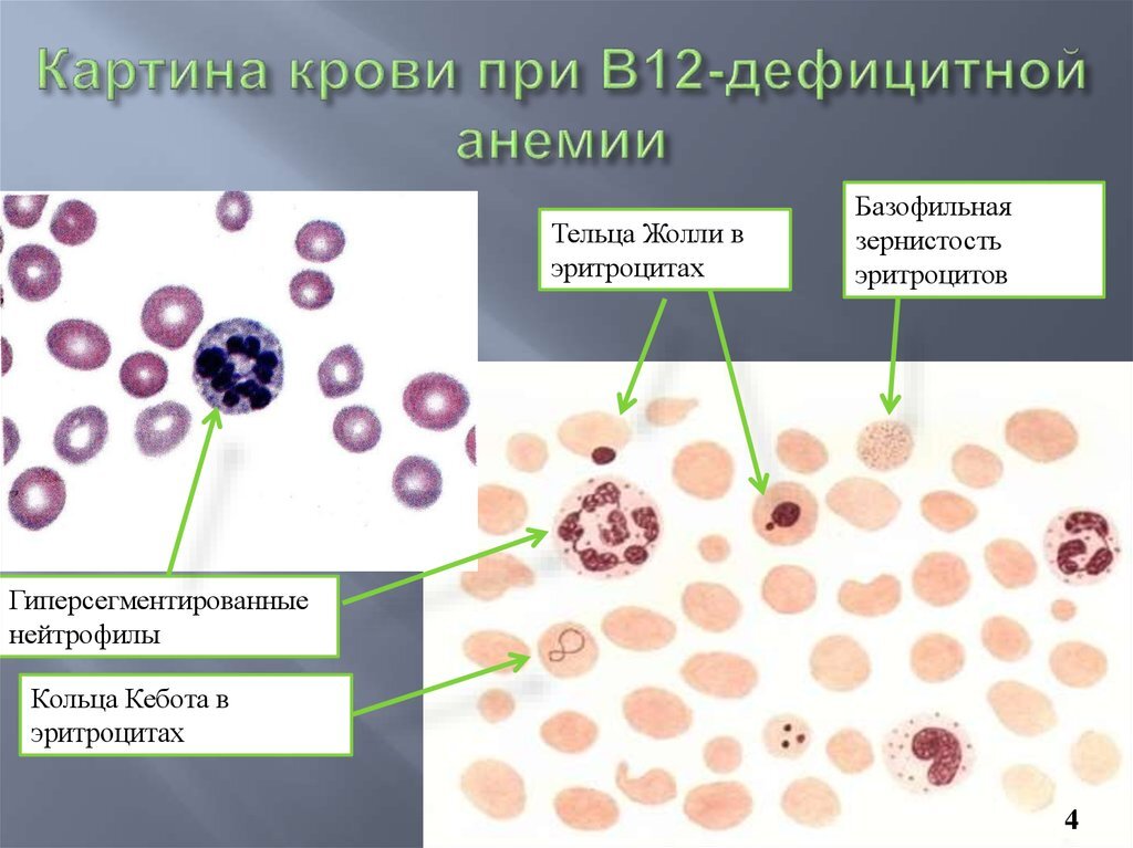 В12-дефицитная анемия. Изображение взято из интернета