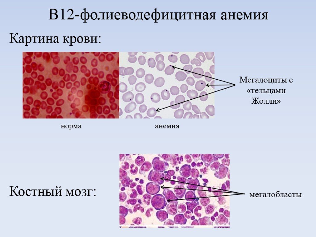 В12-дефицитная анемия. Часто ее еще называют В12-фолиеводифицитная из-за тесной взаимосвязи этих двух витаминов друг с другом. Изображение взято из интернета