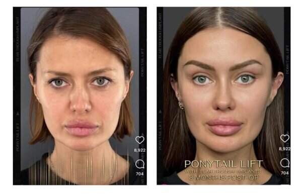 Виктория боня до пластики. Какую операцию сделали боне. Виктория боня блефаропластика. Какую операцию сделали боне. Какую операцию сделали боне.