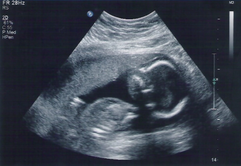 Узи 6 месяцев. УЗИ на 6 месяце беременности. УЗИ ребенка на 5 месяце беременности. 6 Месяц беременности УЗИ мальчик. УЗИ 3 месяца беременности мальчик.