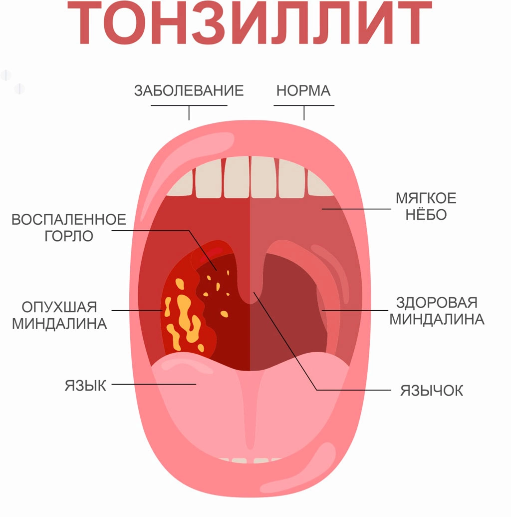 Тонзиллит лечение домашними средствами