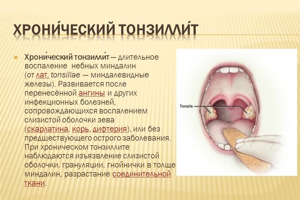 Хронический тонзиллит