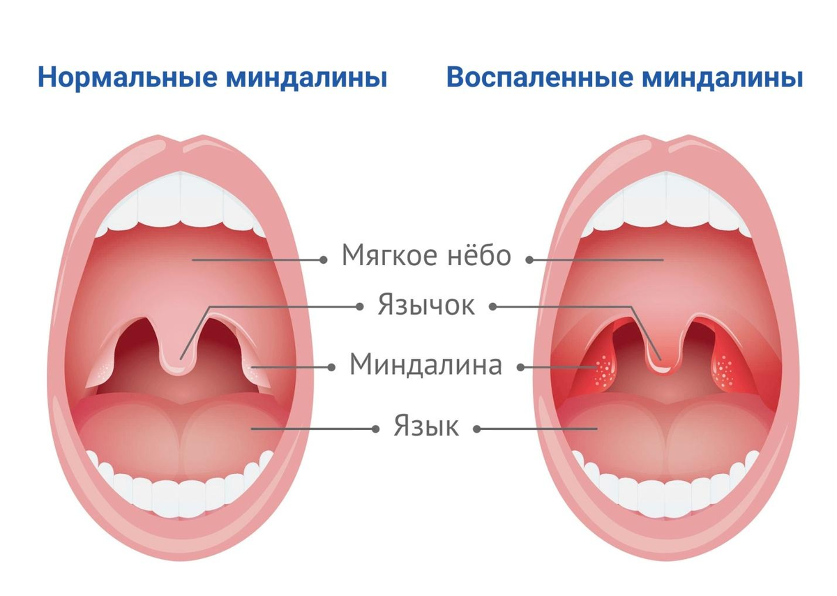 Почему у человека болит горло