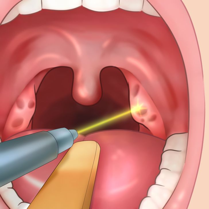 Камни в горле фото Вечно больное горло и ангины: что такое хронический тонзиллит и удалять ли минда