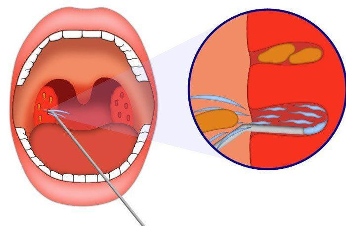 Как чистят миндалины в горле фото Вечно больное горло и ангины: что такое хронический тонзиллит и удалять ли минда