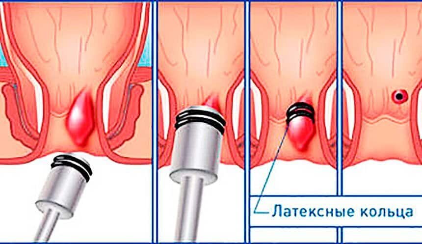 Малоинвазивное лечение геморроя. Латексное лигирование геморроидальных узлов. Лигирование геморроя латексными кольцами. Латексные кольца для лигирования геморроидальных узлов. Внешний геморроидальный узел.