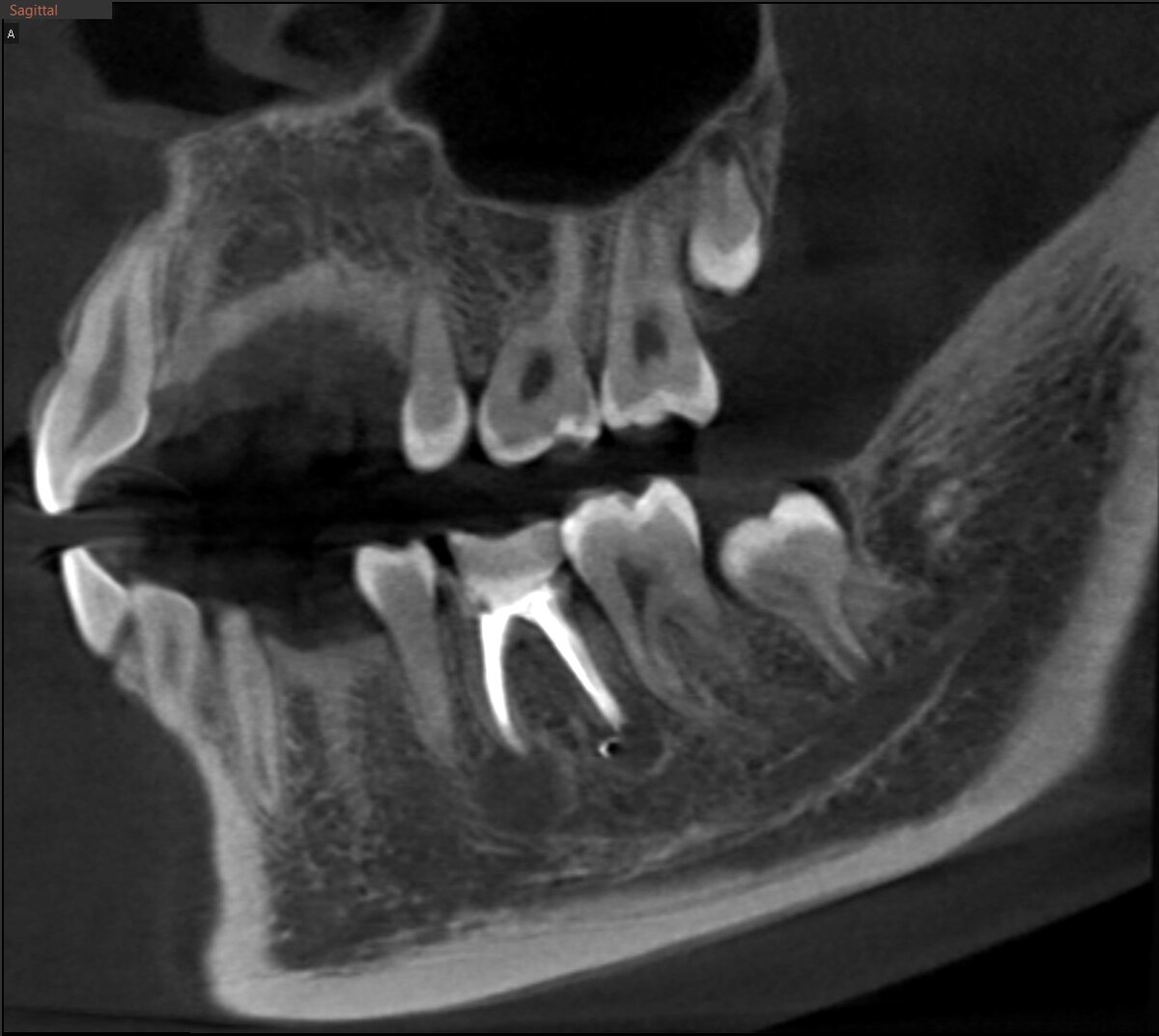 шатаются коренные зубы у подростка