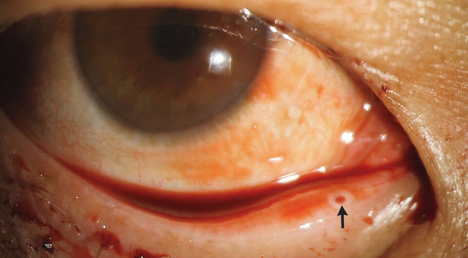   Tao Zhang, Yong Tao / NEJM, 2024