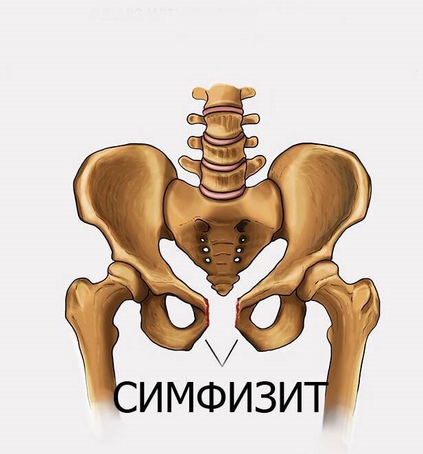 Симфиз лобковой кости кости. Болит лобковая. Симфизит тазобедренного сустава. Симфизит лонного сочленения кт. Стабилизаторы таза.