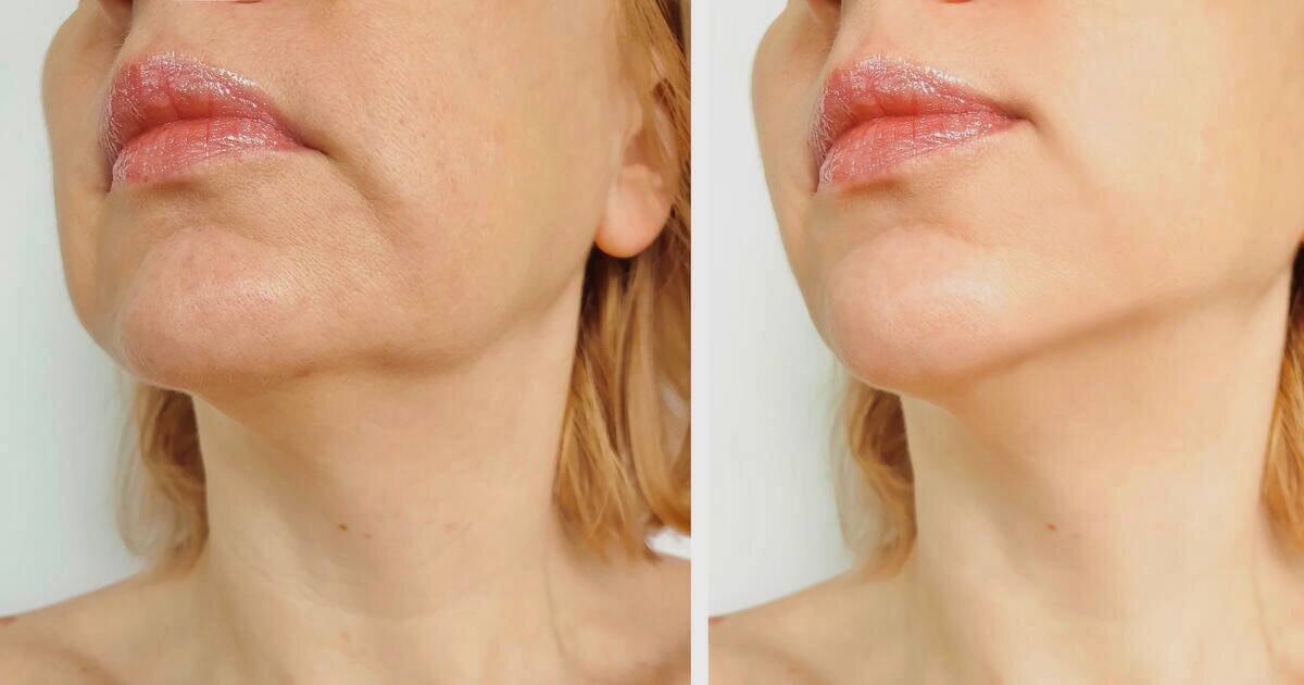 Брыли упражнения для лица. Уколы от брылей на лице. Убрать брыли ботоксом. Убрать брыли ботоксом. Лифтинг нефертити ботоксом.