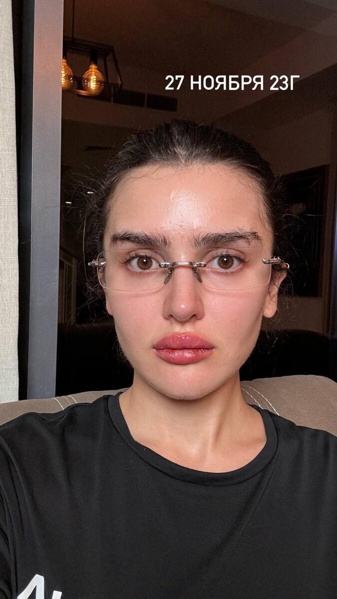 пролактиновая гинекомастия. эстрадиоловая гинекомастия. остеохондропатический кифоз. остеохондропатический кифоз. пластика груди.