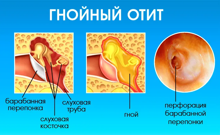 Тубоотит сколько длится. Острый наружный средний отит. Острый Гнойный средний отит ухо. Средний отит барабанная перепонка.