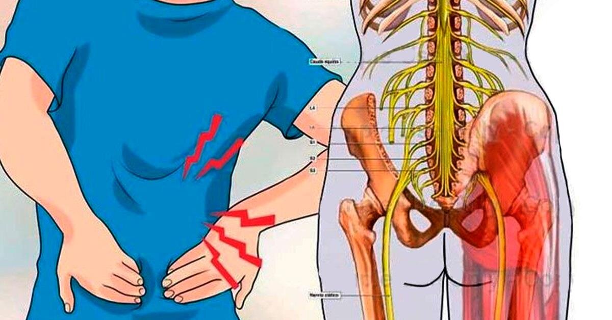 Спиной нерв. Поясничный отдел позвоночника седалищный нерв. Защемление седалищного нерва грыжей позвоночника. Защемление нерва. Что делать при защемлении нерва в спине.