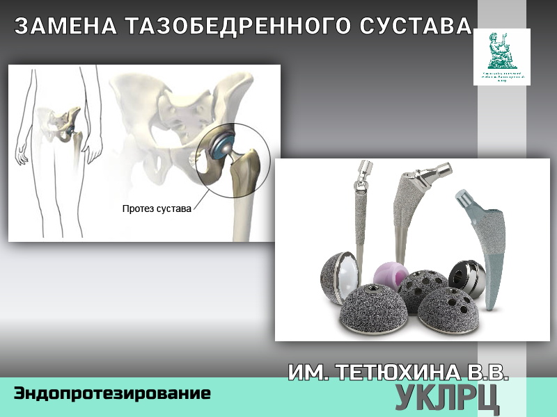 ЗАМЕНА ТАЗОБЕДРЕННОГО СУСТАВА