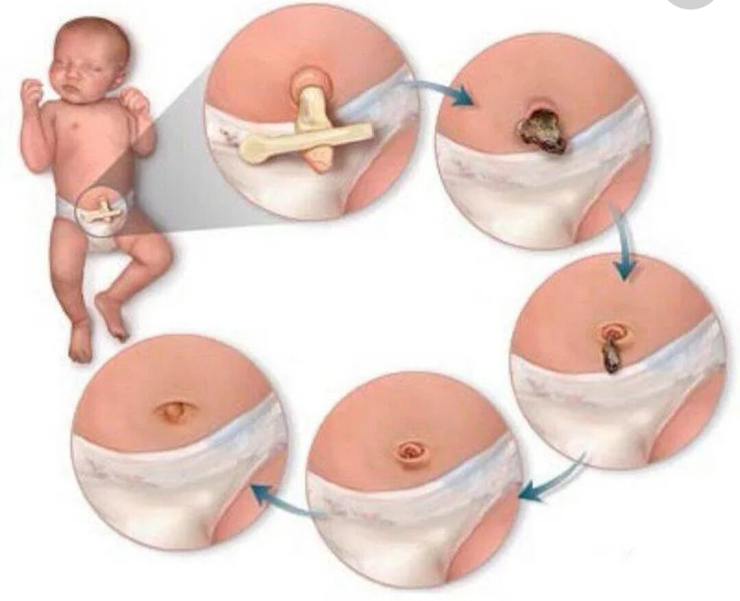 Норма заживления пупочного остатка у новорождённого ребёнка 📌