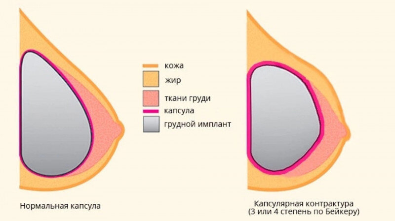 Как должна выглядеть грудь