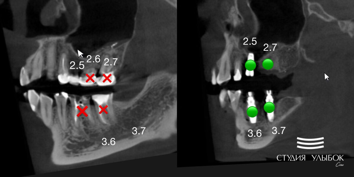 имплантация челюсти на 4 имплантах. наращивание костной ткани на верхней челюсти. импланты на верхнюю челюсть при отсутствии. импланты на верхнюю челюсть при отсутствии. протез на 4 имплантах верхней челюсти.