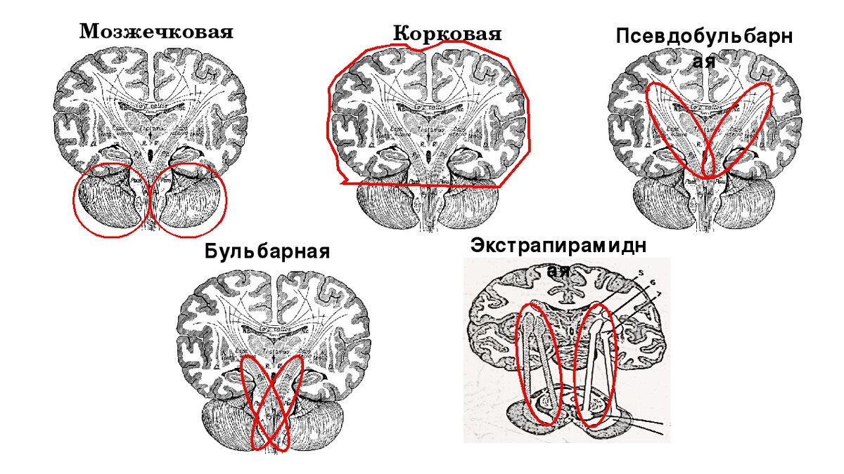 Дизартрия головного мозга. Подкорковая дизартрия очаг поражения. Псевдобульбарная дизартрия очаг поражения мозга. Очаг поражения при псевдобульбарной дизартрии. Мозжечковая дизартрия очаг поражения.