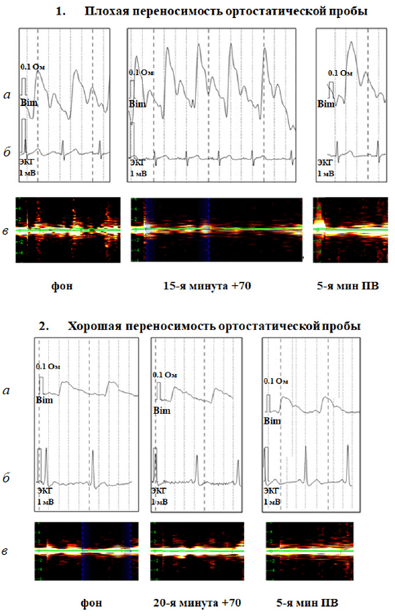 Исследование церебральной гемодинамики и периферической микроциркуляции при  проведении пассивной постуральной ортостатической пробы | Минимакс | Дзен