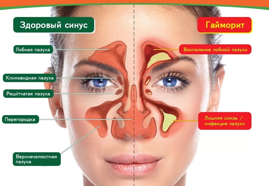 Лечение гайморита