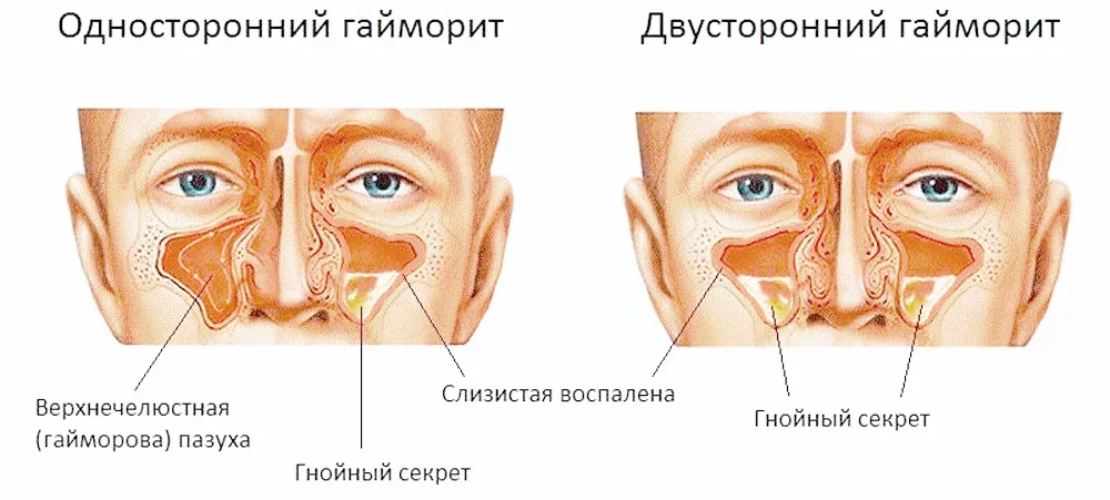 Можно ли гайморите. Острый двусторонний гайморит, фронтит. Острый двусторонний Гнойный синусит. Хронический двусторонний Гнойный гайморит. Двусторонний экссудативный гайморит.