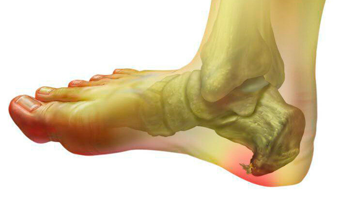 пяточная шпора массаж видео.