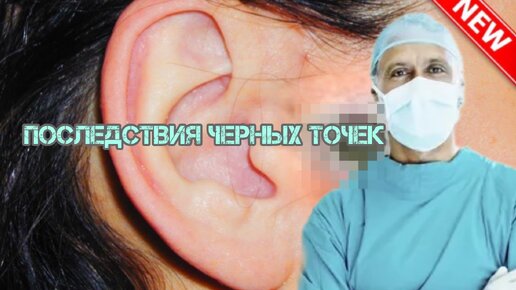 В самую точку! Как избавиться от черных точек в ушах