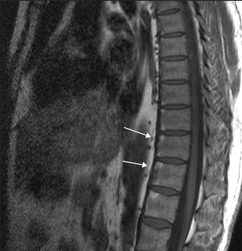      Romanus lesions