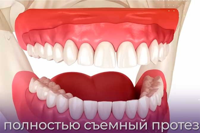 Съемное протезирование