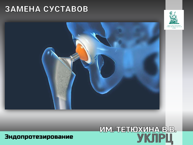 Эндопротез коленного сустава операция. Эндопротезирование коленного сустава операция. Тотальный эндопротез коленного сустава. Замена коленного сустава сколько болит. Остеоартроз эндопротезирование.