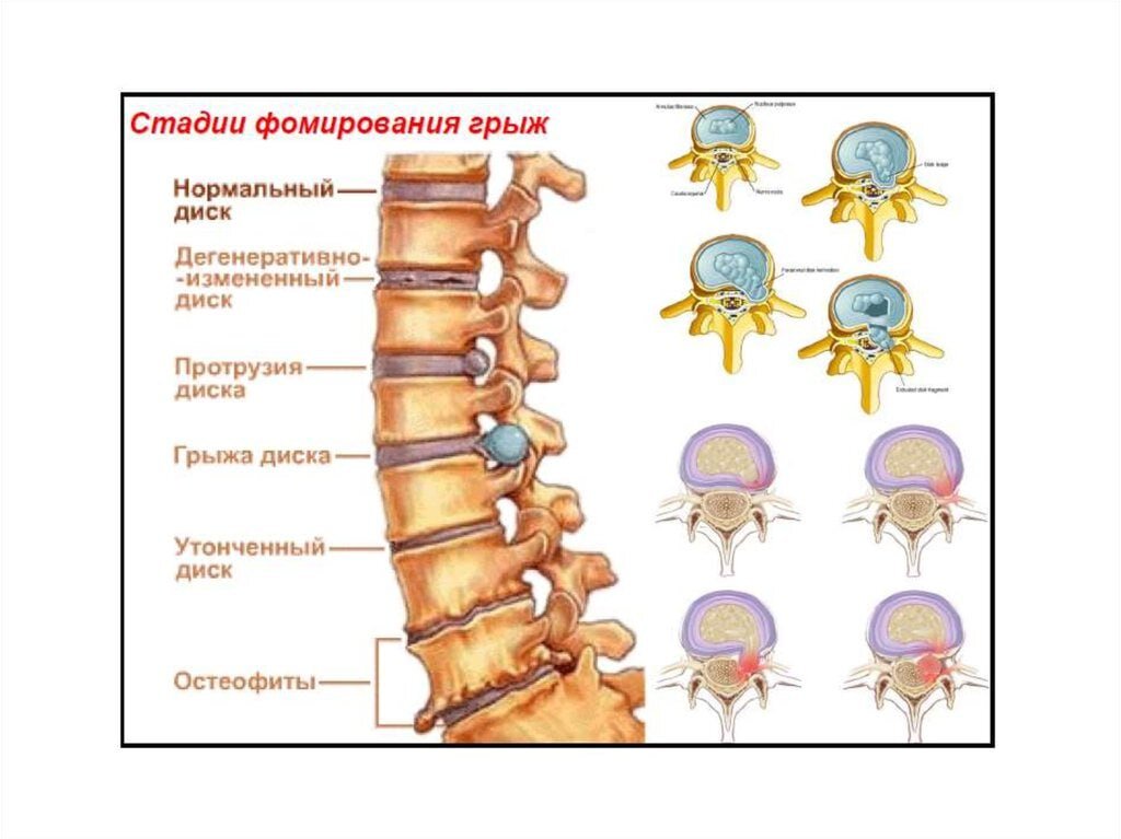 Виды грыж позвоночника поясничного