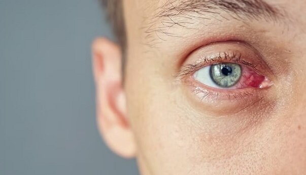 "Лопнувшие" сосуды в глазах — один из настораживающих симптомов