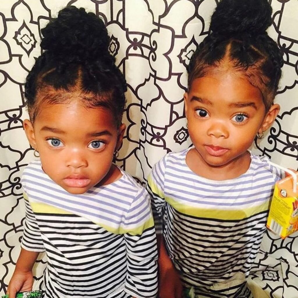 Волшебные глазки как выглядят подросшие сестрички-близняшки, которые  родились с редкой генетической особенностью | Пульс Истории | Дзен