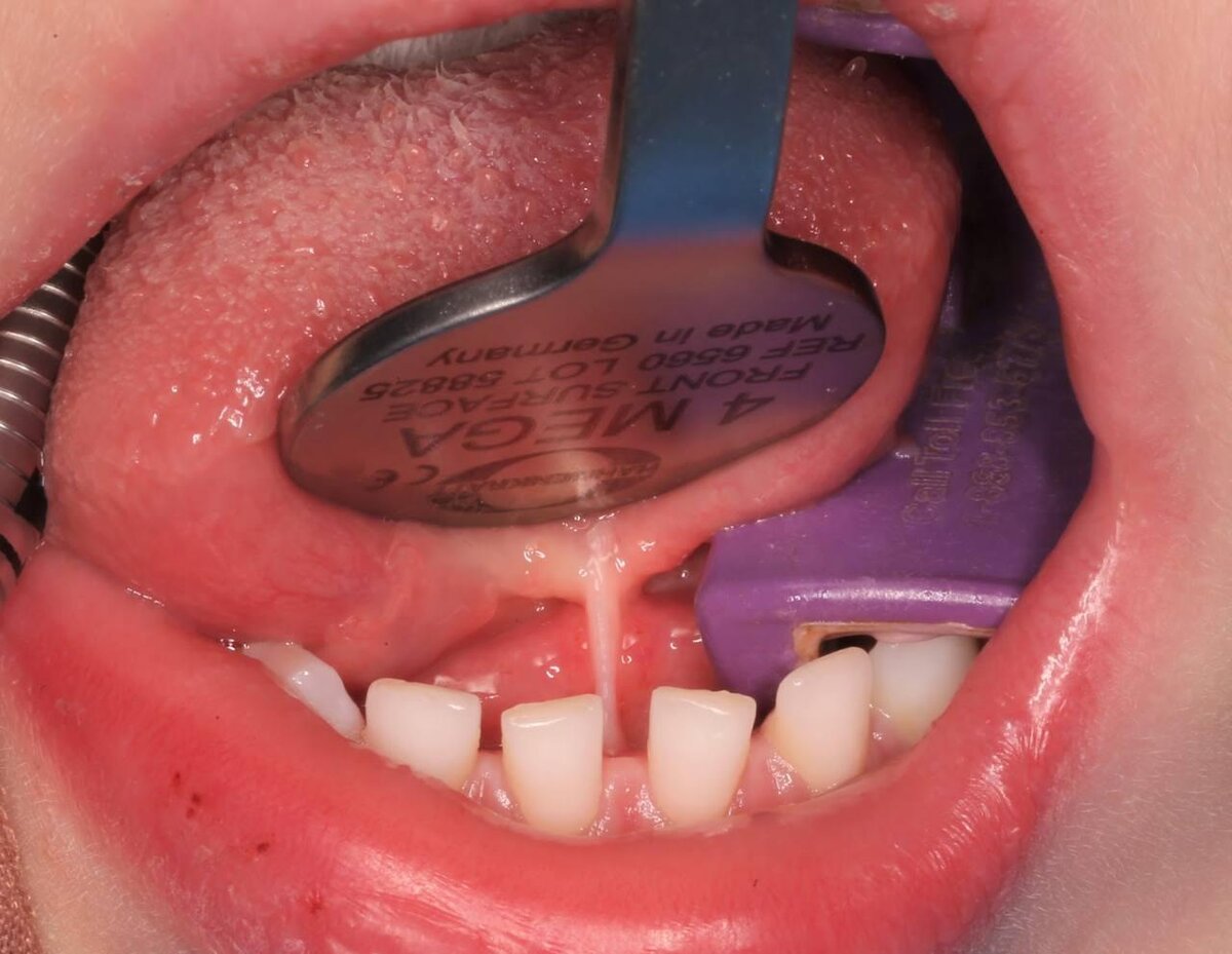 Уздечка языка выполняет очень важную функцию — она прикрепляет язык к мягким тканям полости рта, предупреждая его западание.